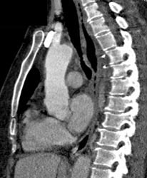 Post Arch Repair - CTisus CT Scan