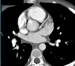 Soft Plaque Narrows LAD - CTisus CT Scan