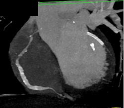 RCA Stenosis With Stents - CTisus CT Scan