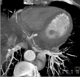 Cardiac Veins - CTisus CT Scan