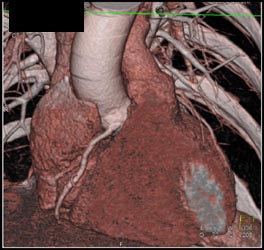 Higher Origin of RCA - CTisus CT Scan