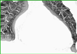 Motion Related Artifact in RCA - CTisus CT Scan