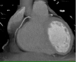 RCA Seen Well When Reconstructed Done in Correct Phase - CTisus CT Scan