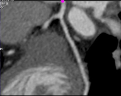 Circumflex Stenosis - CTisus CT Scan