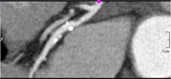 Multiple Plaques - CTisus CT Scan