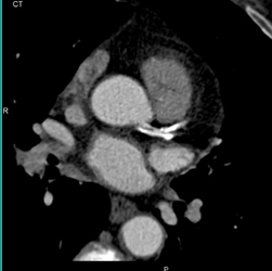 Artifact Off Dense Calcification - CTisus CT Scan