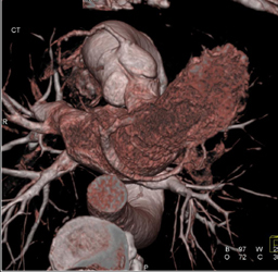Multiple Plaques in RCA - CTisus CT Scan