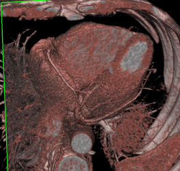 LAD and Circumflex Off Left Cusp - CTisus CT Scan