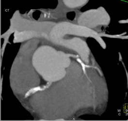 Air in Right Side of Heart - CTisus CT Scan