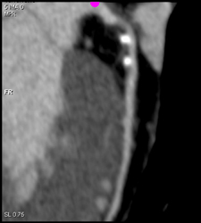 RCA Plaques - CTisus CT Scan