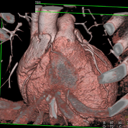 Soft Plaque LAD - CTisus CT Scan
