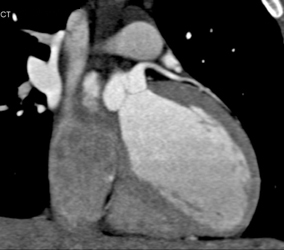 Soft Plaque LAD - CTisus CT Scan