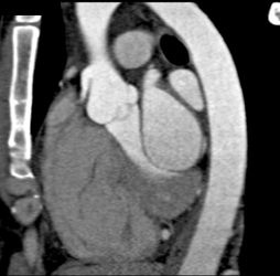 Soft Plaque LAD - CTisus CT Scan