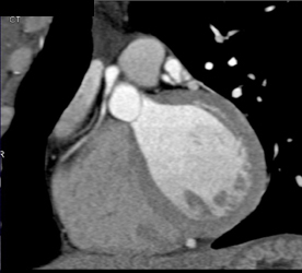 Soft Plaque LAD - CTisus CT Scan