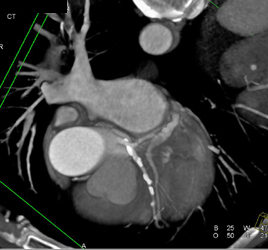 Soft Plaque LAD - CTisus CT Scan