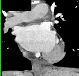 Plaque in LAD - CTisus CT Scan