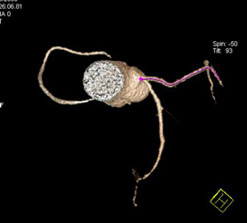 LAD Disease - CTisus CT Scan