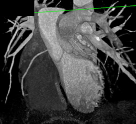 LAD Disease - CTisus CT Scan