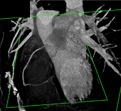 LAD Disease - CTisus CT Scan