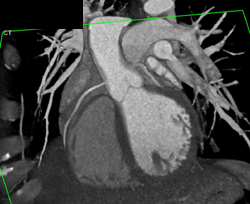LAD Disease - CTisus CT Scan