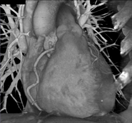 LAD Disease - CTisus CT Scan