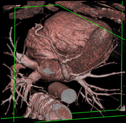 LAD Stenosis - CTisus CT Scan