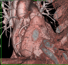 Stent in LAD - CTisus CT Scan