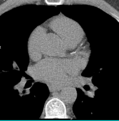 LAD Stenosis - CTisus CT Scan