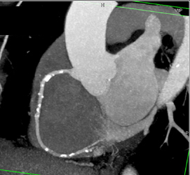 LAD Stenosis - CTisus CT Scan