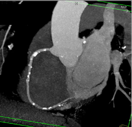 Calcified Bicuspid Valve - CTisus CT Scan