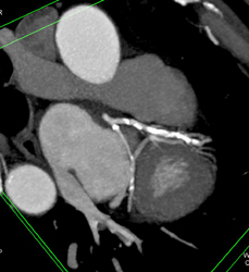 Normal LAD With RCA Off Left Cusp - CTisus CT Scan