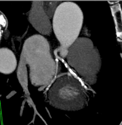 Normal Right Coronary Artery - CTisus CT Scan
