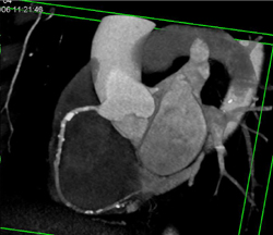 Normal Right Coronary Artery - CTisus CT Scan