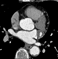 Normal Right Coronary Artery - CTisus CT Scan