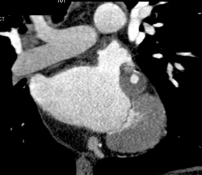 Normal Right Coronary Artery - CTisus CT Scan