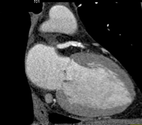 Normal Right Coronary Artery - CTisus CT Scan