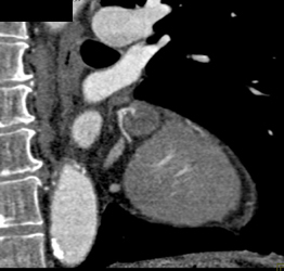 Normal Right Coronary Artery - CTisus CT Scan