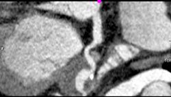 RCA Off the Left Cusp - CTisus CT Scan