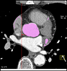 Calcified Coronary Artery and Dissection - CTisus CT Scan