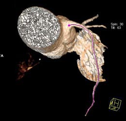 Plaque in LAD - CTisus CT Scan