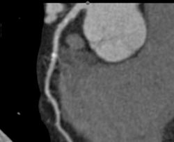 Plaque in LAD - CTisus CT Scan