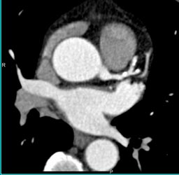 Plaque in LAD - CTisus CT Scan