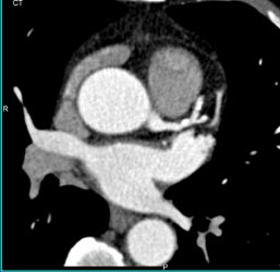 Plaque in LAD - CTisus CT Scan
