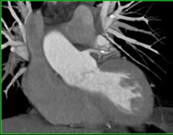 LAD Plaque - CTisus CT Scan