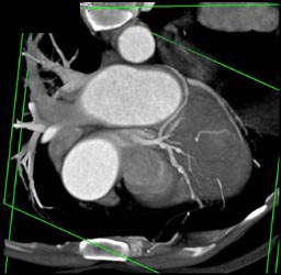 LAD Plaque - CTisus CT Scan