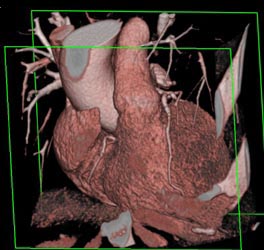 LAD Plaque - CTisus CT Scan