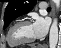 LAD Plaque - CTisus CT Scan