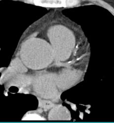 Plaque in LAD and Ramus Intermedius - CTisus CT Scan