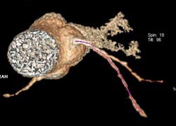 Myocardial Bridging - CTisus CT Scan