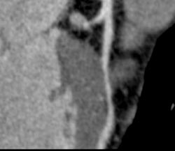 Myocardial Bridging - CTisus CT Scan